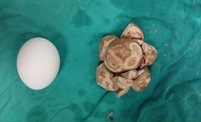 İdrar Kesesinde Taş Belirtileri ve Tedavisi