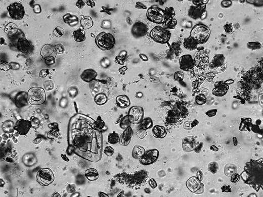 İdrar Kristalleri Nedenleri?