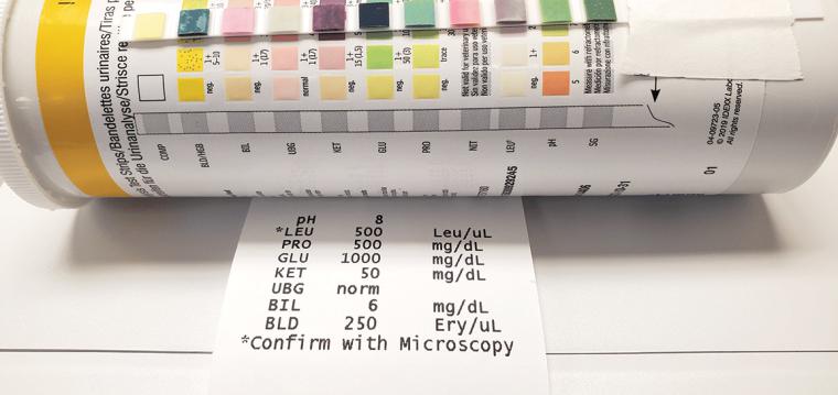 İdrar Tahlilinde Sg Yüksekliği Nedir?