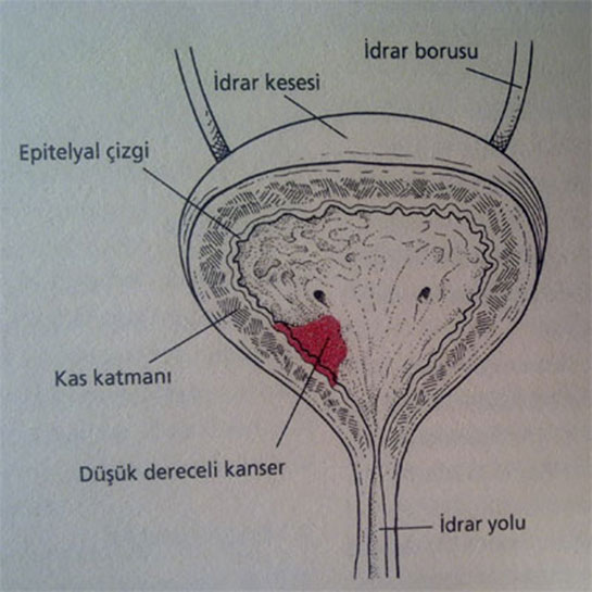 drar Torbas Kanseri