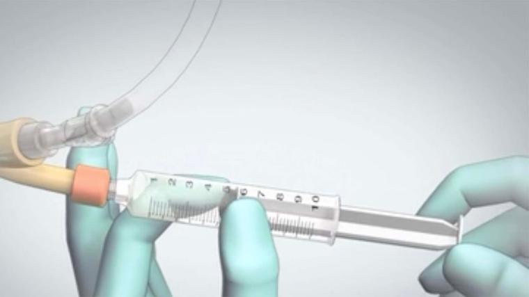 Sonda Çıkarıldıktan Sonra Yanma Nasıl Geçer?